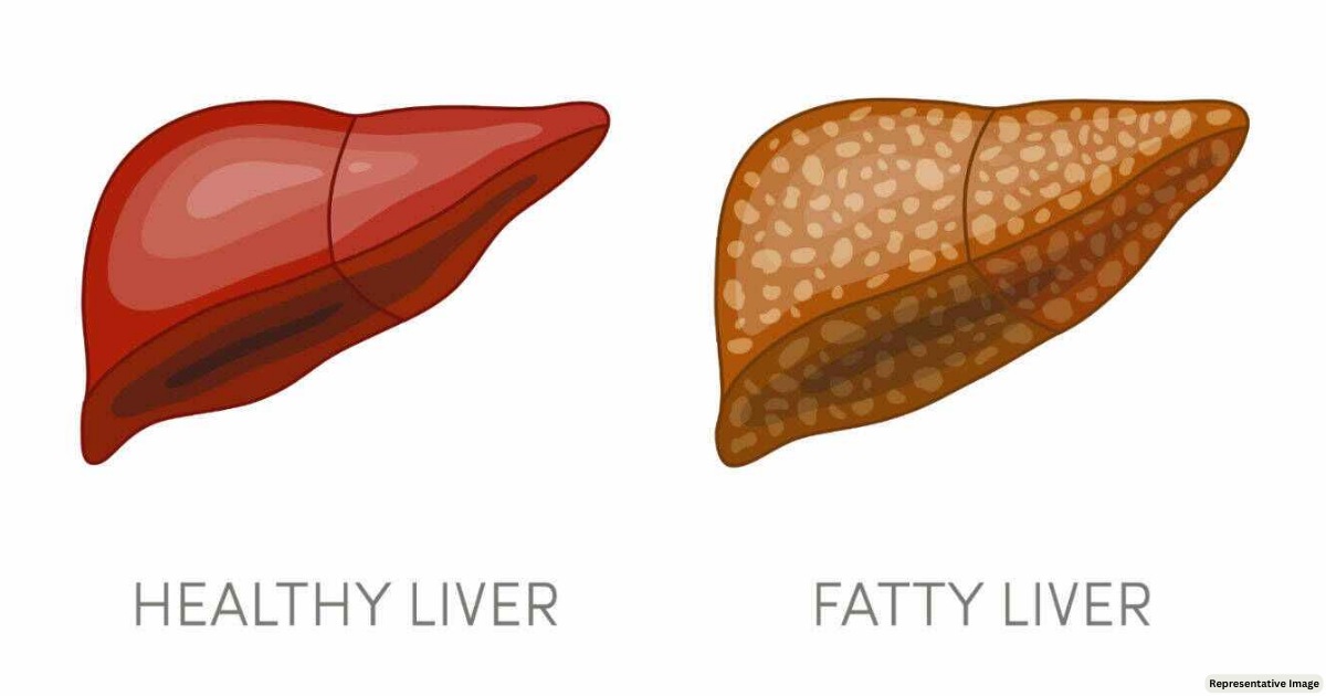 Fatty Liver Disease: A Growing Health Problem in India
